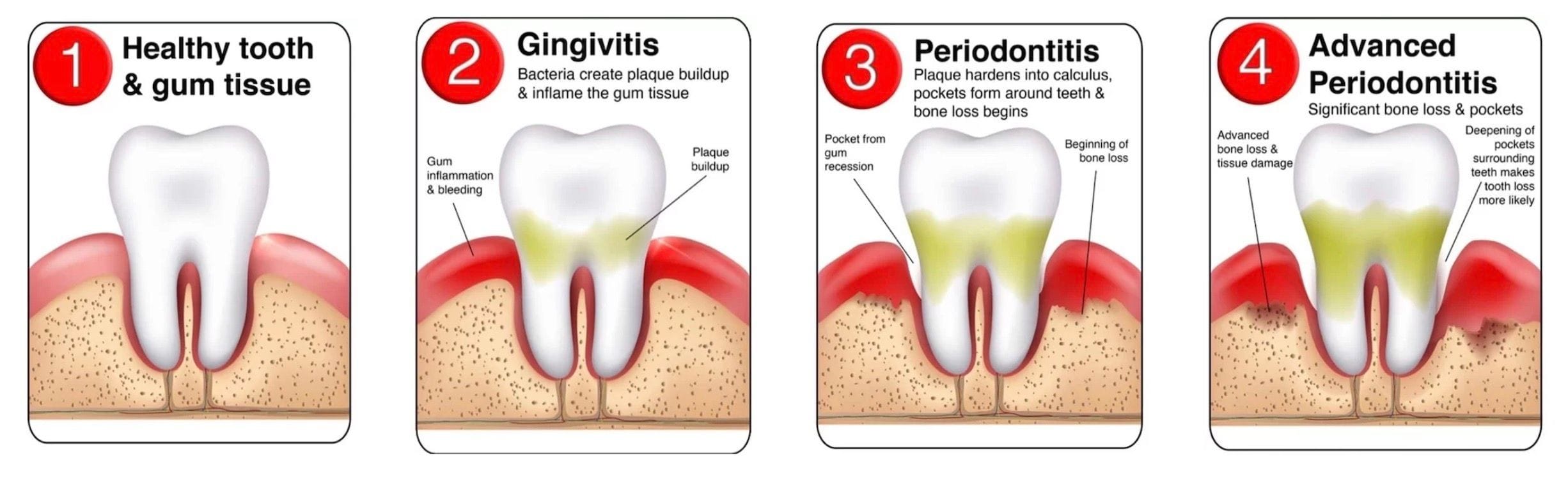 Visual representation of stages of periodontal disease: from mild inflammation to advanced gum recession, highlighting the importance of early intervention