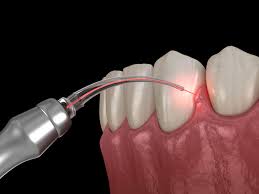 Experience precision in laser gum treatment at Mint Dental—Biolase diode lasers ensure effective periodontal care for optimal gum health.